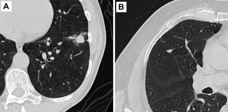 Lung cancer screening dramatically increases long-term survival rate