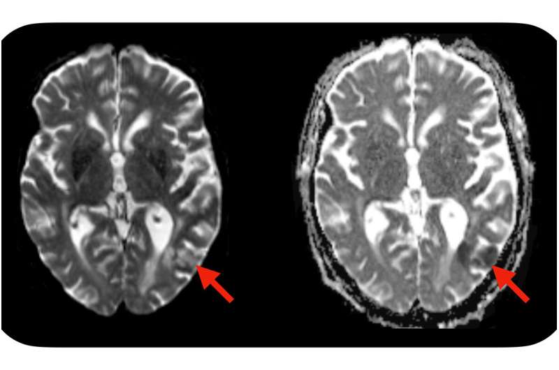 Simple blood test predicts neurotoxic complications of CAR-T cell therapy 