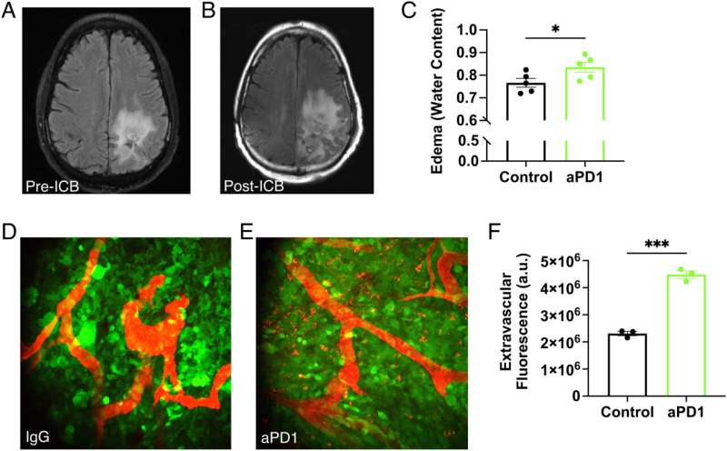 Blood pressure drug may prevent immunotherapy-induced brain swelling in patients with glioblastoma