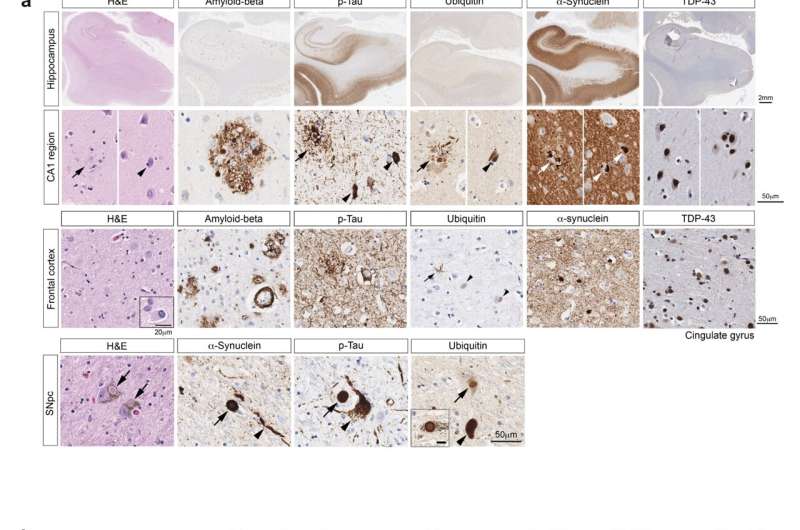 Parkinson's disease: When the cellular waste collector doesn't show up