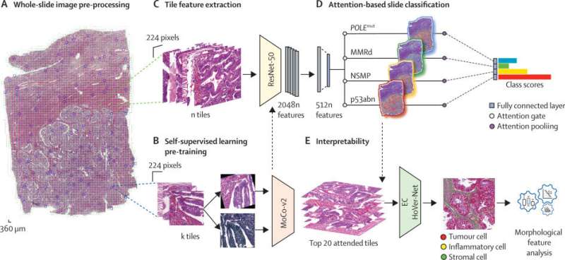 AI application in pathology reveals novel insights in endometrial cancer diagnostics