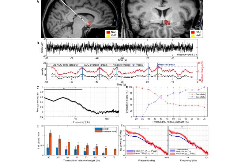 Brain implant successfully controls both seizures and OCD