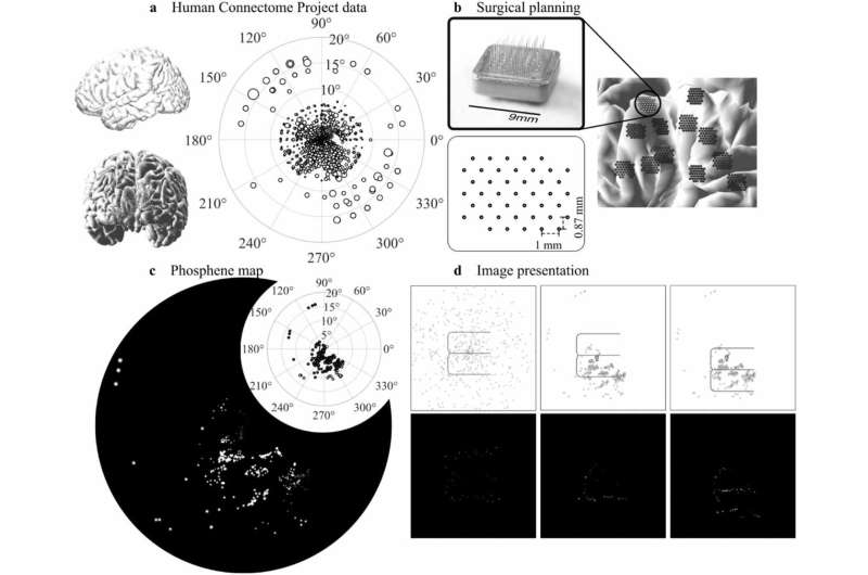 A better 'map' of the lights you see when you close your eyes can improve 'bionic eye' outcomes