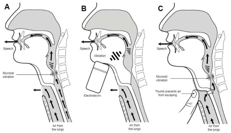 Research suggests AI will become a translator for patients after laryngectomy