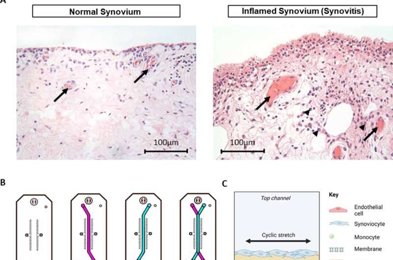 New organ-on-a-chip model of human synovium could accelerate development of treatments for arthritis