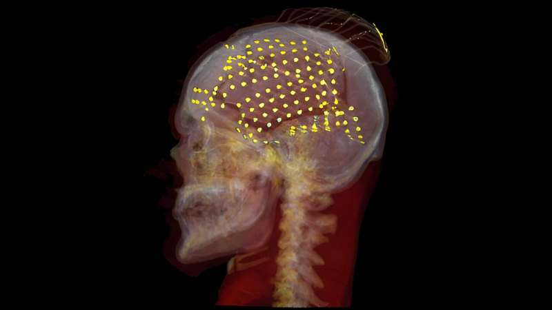 Researchers reconstruct speech from brain activity, illuminating complex neural processes