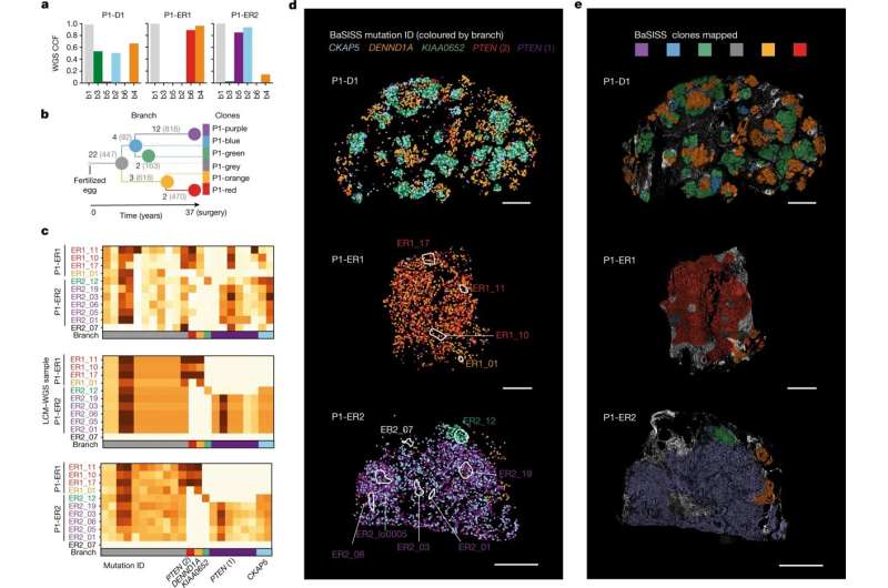 Breast cancer spread uncovered by new molecular microscopy