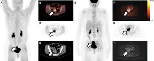 New Research: FAPI PET Imaging Superior for Diagnosing Multiple Types of Cancer, with Potential for Targeted Treatment