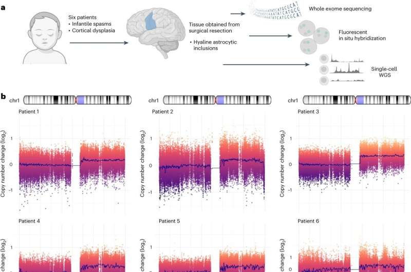 Novel cause of brain mosaicism and focal epilepsy identified