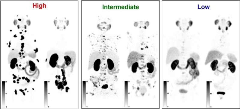 Newly developed PSG score improves patient selection for PSMA radiopharmaceutical therapy