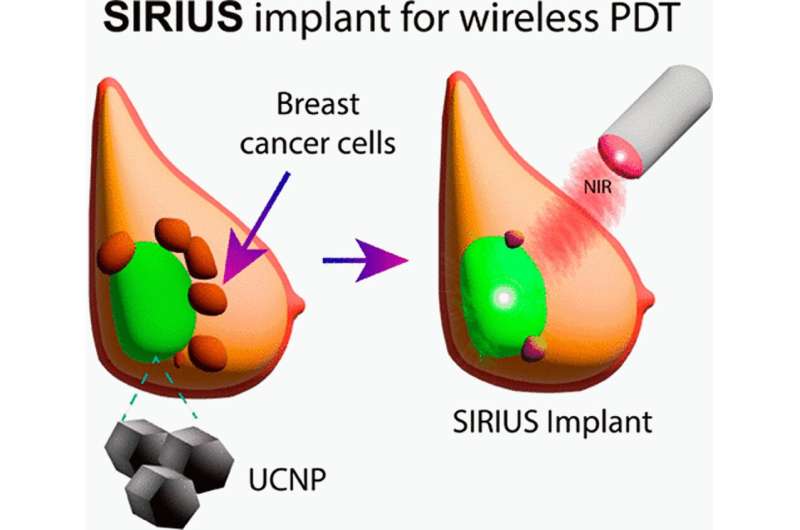 New tumor-selective light treatment could kill breast cancer cells with greater accuracy and improve tumor control