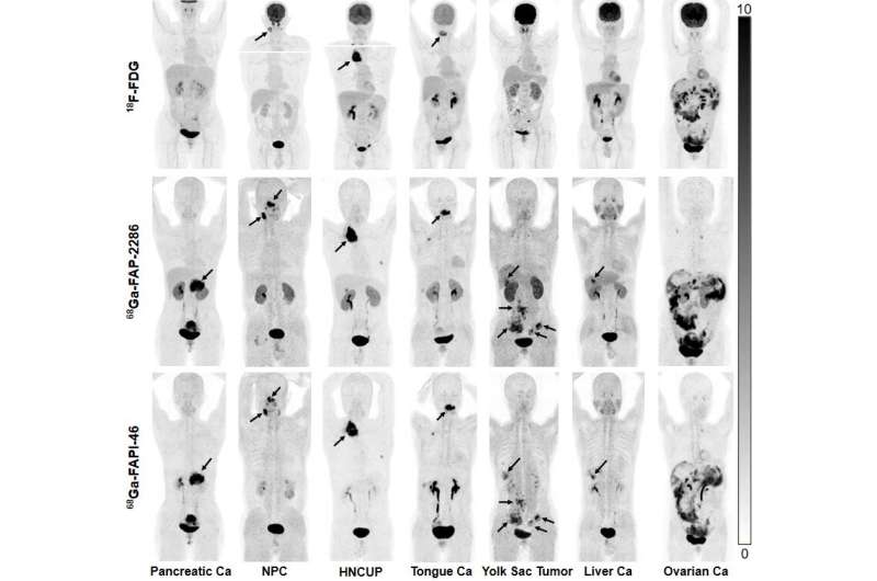 Novel PET radiotracer successfully detects multiple cancers, offers potential for new targeted radionuclide therapy