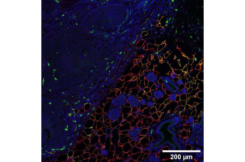 Shape-shifting fat cells fuel breast cancer growth