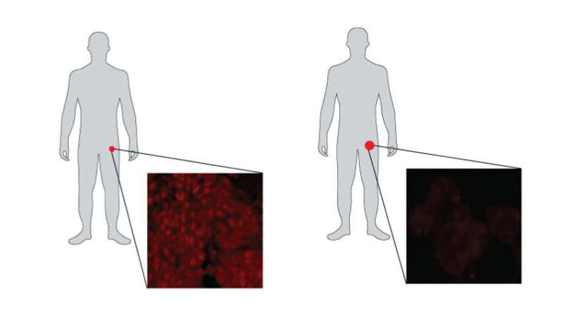 Research suggests commonly used prostate cancer treatment rewires engine of prostate tumors