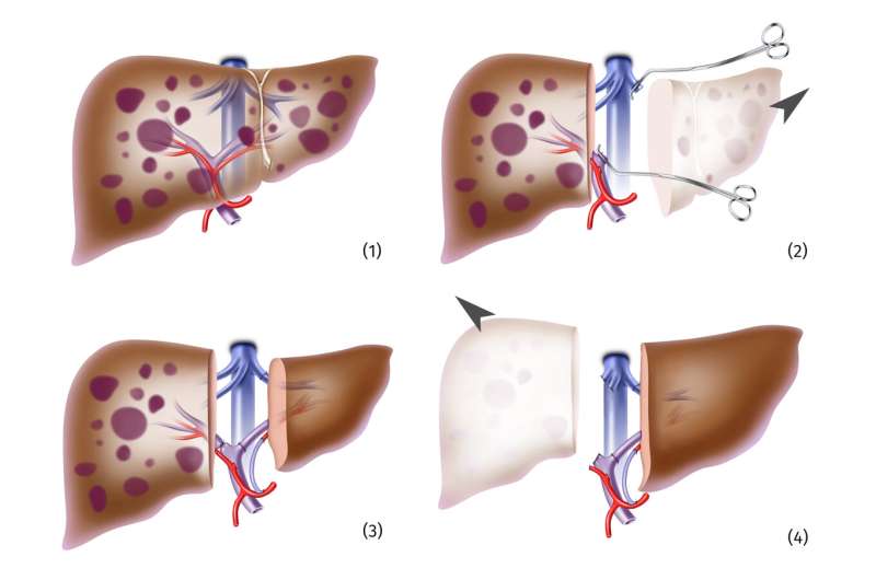 Two-stage transplantation is treatment option for liver metastases