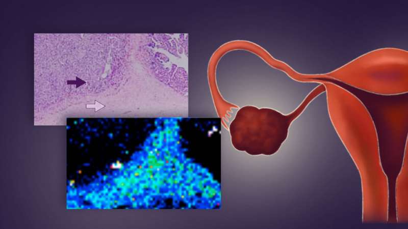 Platinum-based chemotherapy distribution within a tumor predicts ovarian cancer treatment resistance