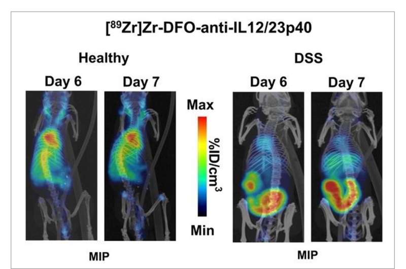 Novel PET radiotracer facilitates early, noninvasive detection of inflammatory bowel disease