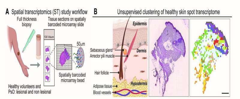 Study helps explain what drives psoriasis severity and offers clues as to how disease may spread to other body parts