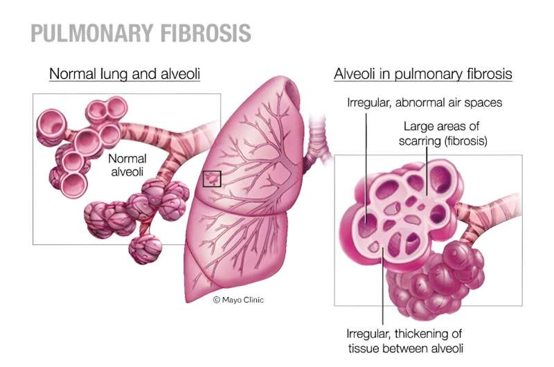 Video: Hypersensitivity pneumonitis—is your feather bedding making you sick?