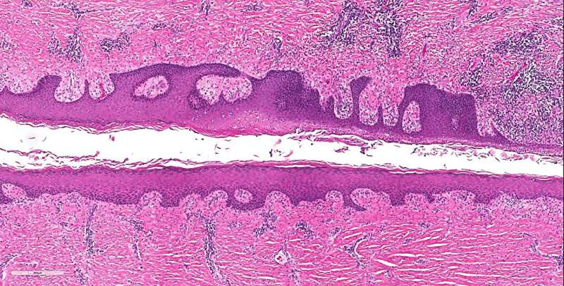 Researchers discover genetic locations for increased risk of hidradenitis suppurativa