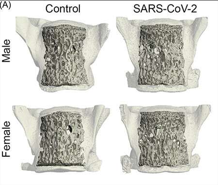 COVID-19 can cause inflammation that results in bone loss, higher fracture risk