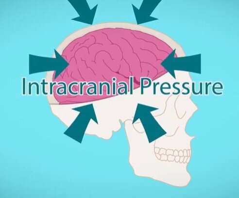 Better than a hole in the head: Modernizing intracranial pressure sensing methods