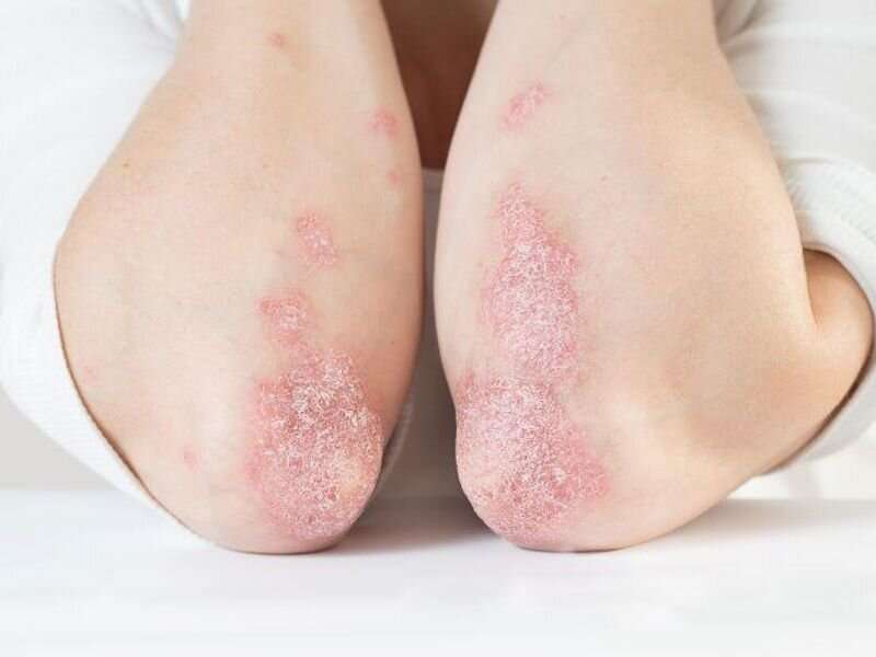 Psoriasis tied to elevated risk for celiac disease