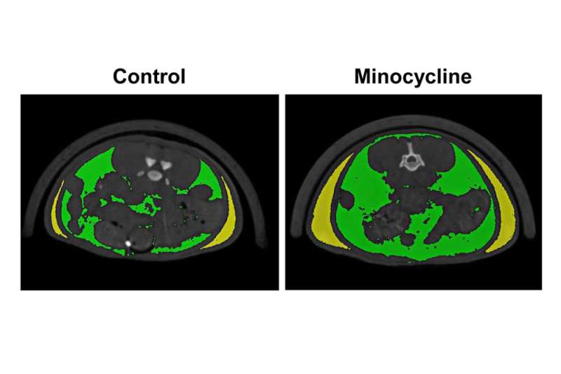 The fat tax: Long-term, systemic antibiotic use for the treatment of adolescent acne can promote fat accumulation