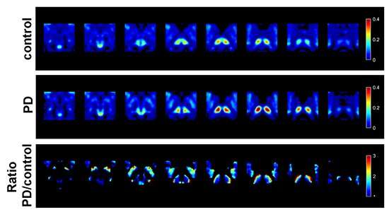 New study details inflammation in early stages of Parkinson's disease