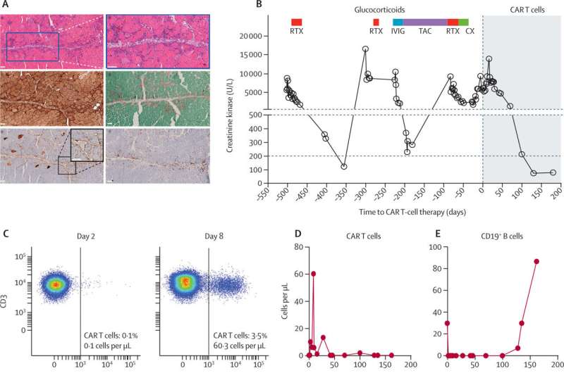 Testing their strength: CAR T-cells combat muscle inflammation