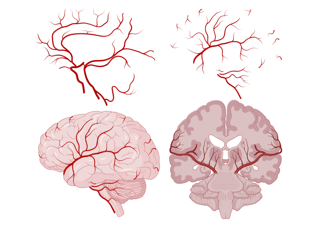 Comparative Efficacy of Tenecteplase versus Alteplase in Thrombolytic Treatment of Acute Ischemic Stroke