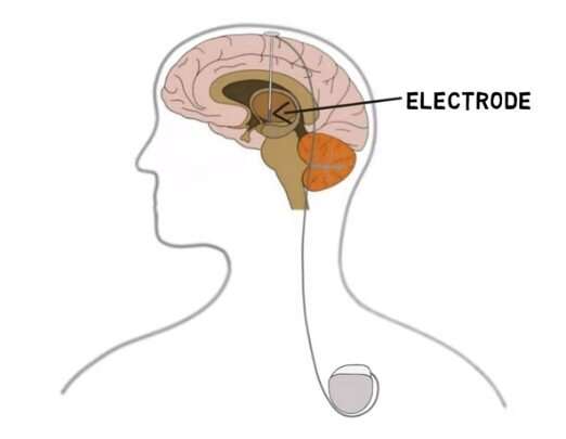 Brain stimulation can rewire and heal damaged neural connections, but it isn't clear how