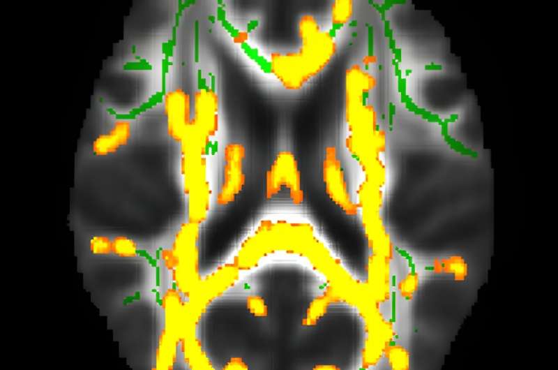 Hidden belly fat in midlife linked to Alzheimer's disease