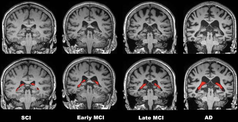 Black patients face delays in Alzheimer's diagnosis, research finds 