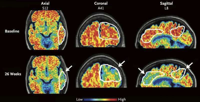 Alzheimer's drugs might get into the brain faster with new ultrasound tool, study shows