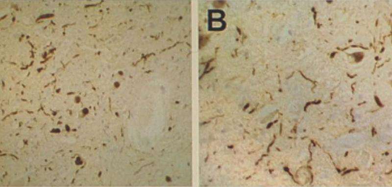 Reducing harmful proteins in the fight against dementia 