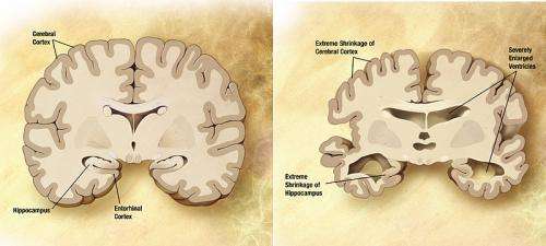 Does fungus cause Alzheimer's? 