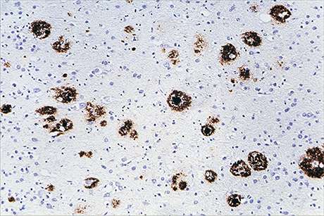 Alzheimer-type brain pathology after transplantation of dura mater 