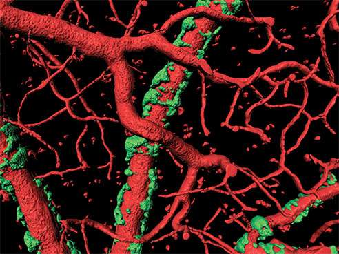 Study says Alzheimer's plaques can also affect the brain's blood vessels 