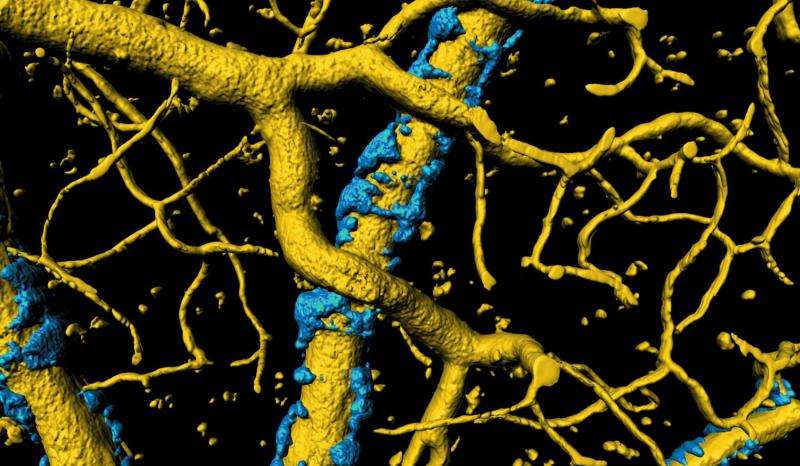 Neuroscientists gain insight into cause of Alzheimer's symptoms 