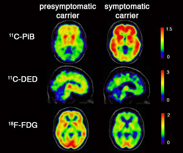 Inflammatory changes in the brain twenty years before Alzheimer onset 