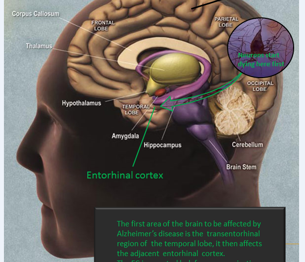 Team suppresses oxidative stress and neuronal death associated with alzheimer’s disease (ad)