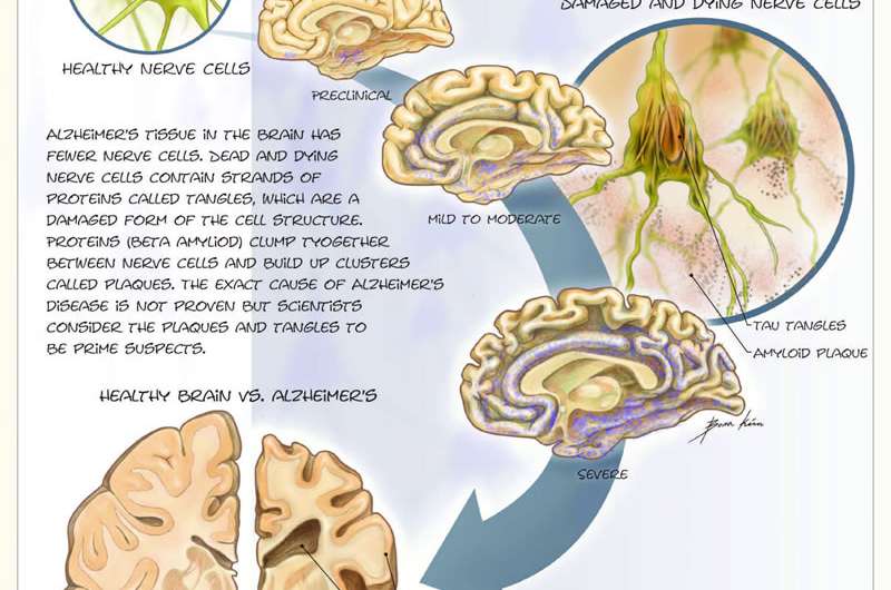 Family found with unusually heritable Alzheimer's risk