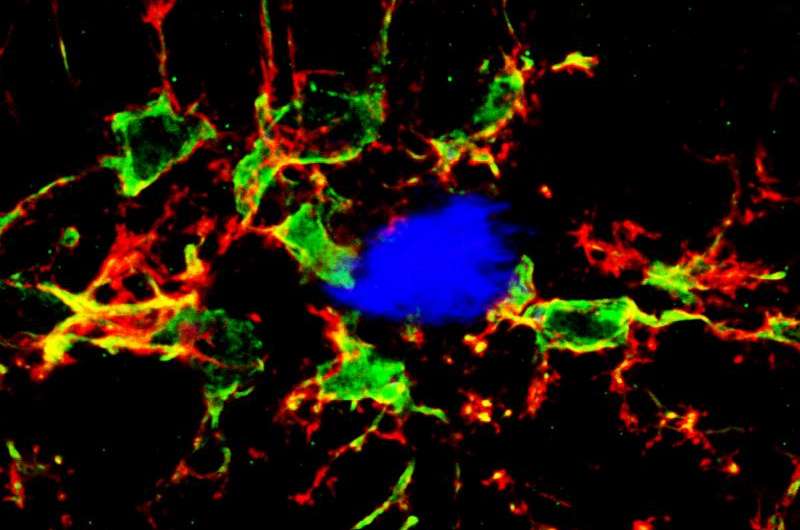 Body's immune system may play larger role in Alzheimer's disease than thought 