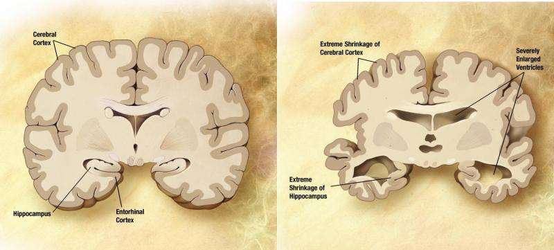 Team suppresses oxidative stress and neuronal death associated with alzheimer’s disease (ad)