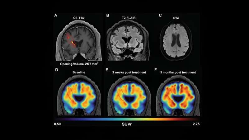 Using focused ultrasound to treat Alzheimer's and Parkinson's 