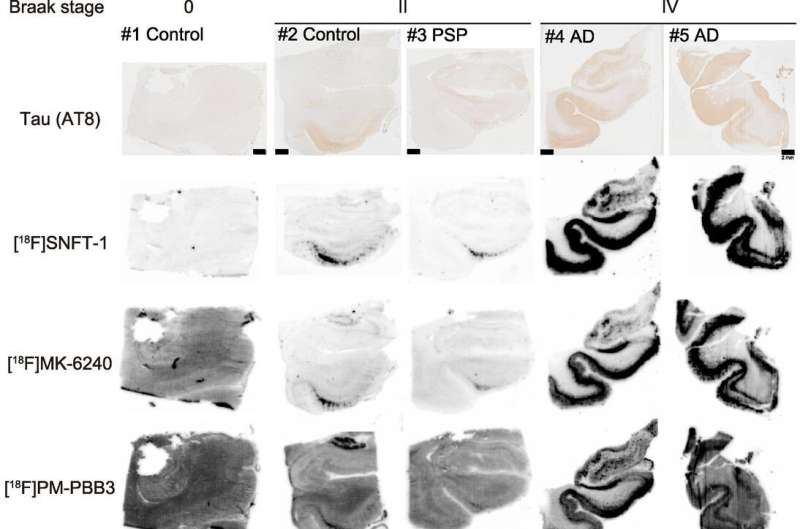 Novel tau PET tracer exhibits high sensitivity and specificity, allowing for earlier ID of Alzheimer's disease