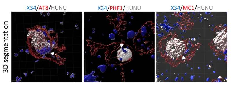 New study discovers how neurons die in Alzheimer's disease 