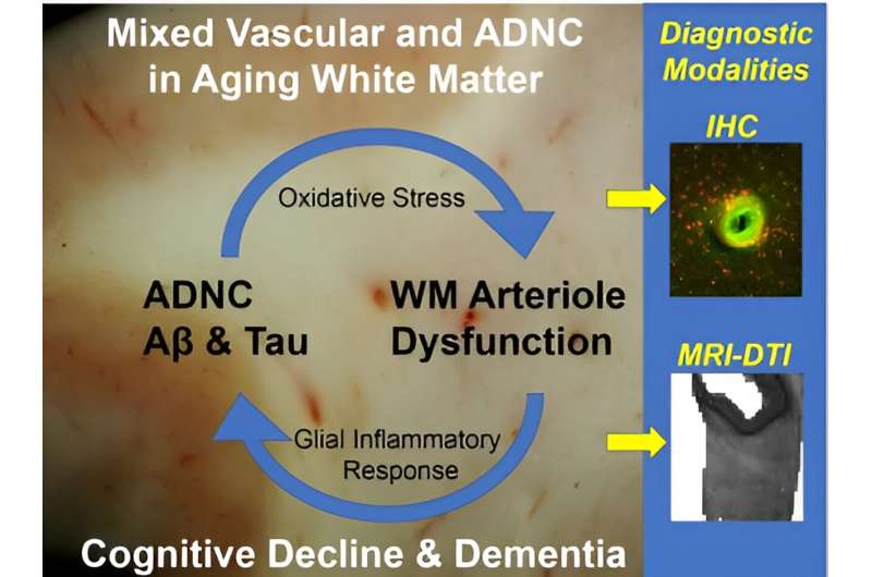 Study reports on contributions to white matter injury in Alzheimer's disease 