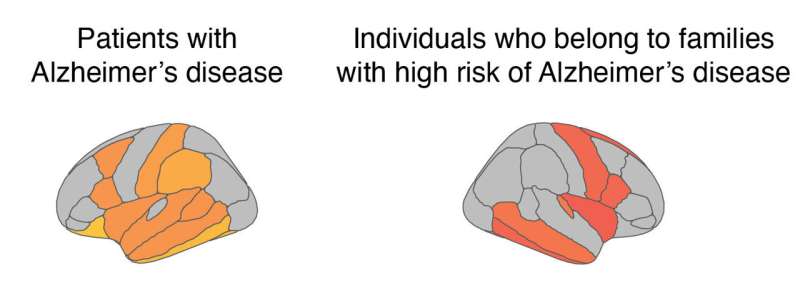 New link between increased astrocytes in the brain and blood in early Alzheimer's disease 